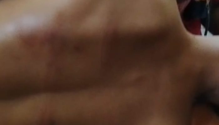 Dugaan Kekerasan Benda Tumpul Oknum Polisi di Lampung Utara: Korban Dapat Jahitan, Telinga dan Hidung Mengeluarkan Darah