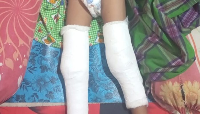 Kaki Dipasang Pen, Siswa Kelas 1 SDN 2 Way Dadi Baru Diduga Jadi Korban Bullying